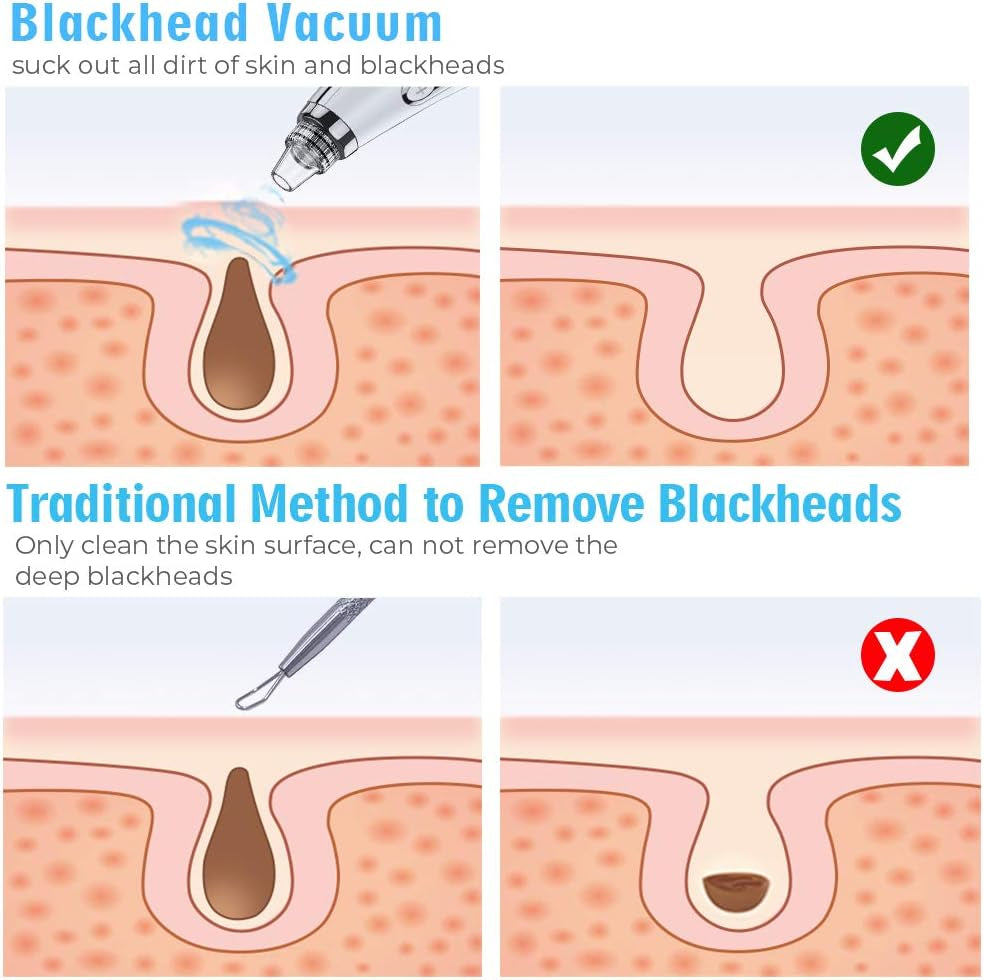 Upgraded Electric Blackhead Remover and Pore Vacuum - 5 Suction Levels, 5 Probes, USB Rechargeable Comedone Extractor Kit for Men and Women