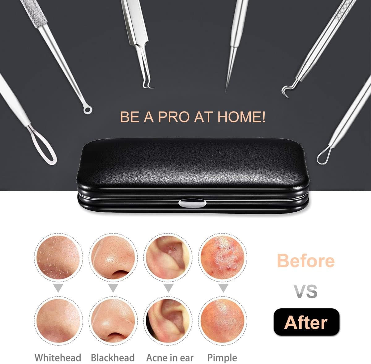 Professional Blackhead Remover Tool Kit - 6-Piece Pimple Extractor Set for Acne, Whiteheads, and Blemishes with Organized Case